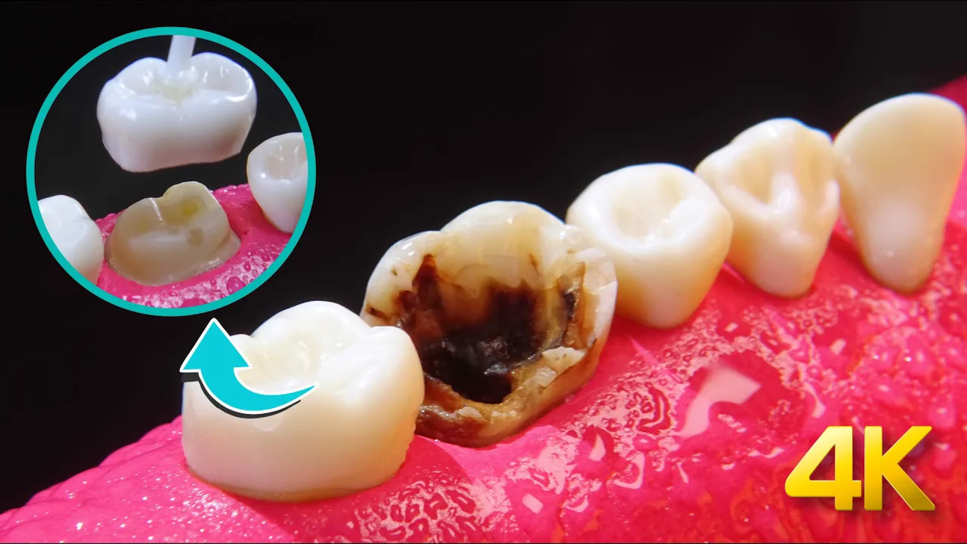 خراب شدن کلی دندان ؛ پوسیدگی گسترده دندان آسیا ؛ ترمیم و عصب کشی رانولازین