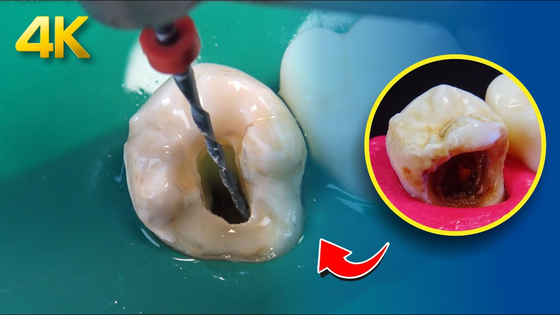 سوراخ شدن دندان و ترمیم آن : پرکردن دندان کرم خورده : پوسیدگی سطحی و عمقی دندان In Situ Hybridization