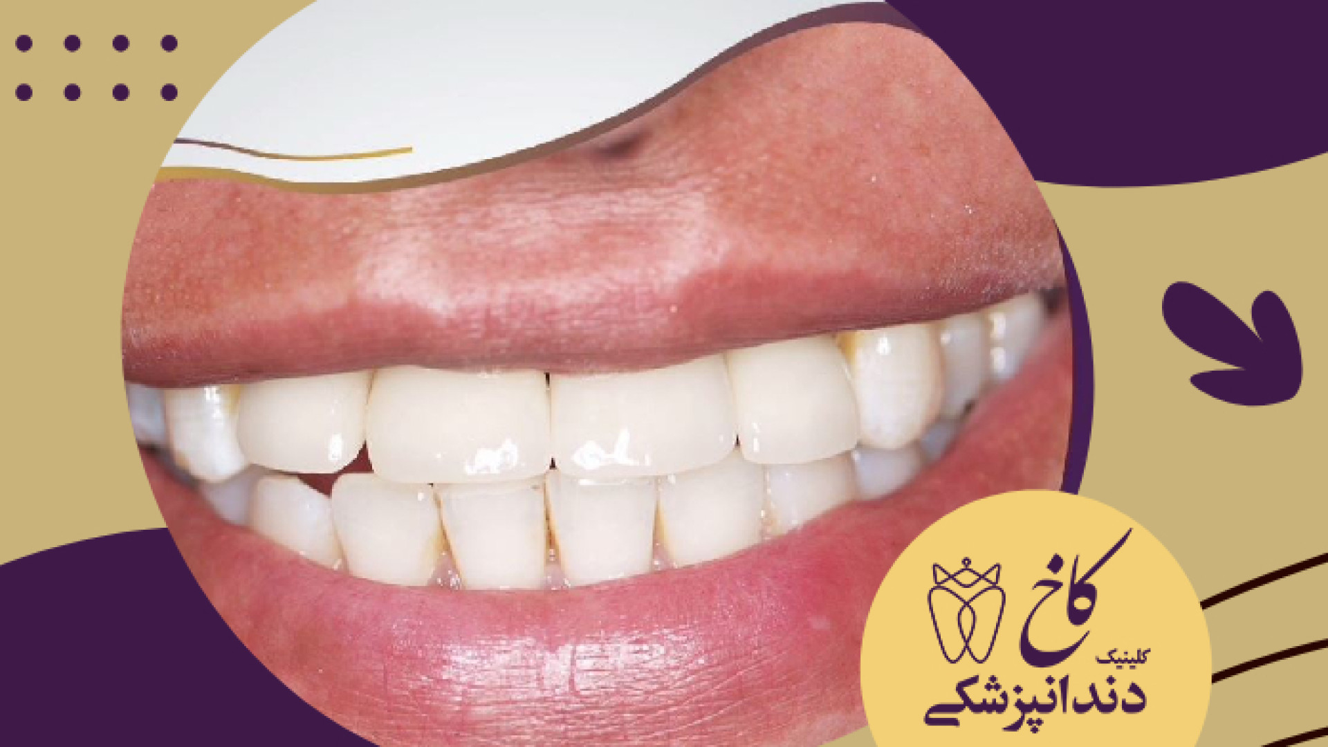 ایمپلنت ماندگار بعد 17 سال کلینیک دندانپزشکی کاخ