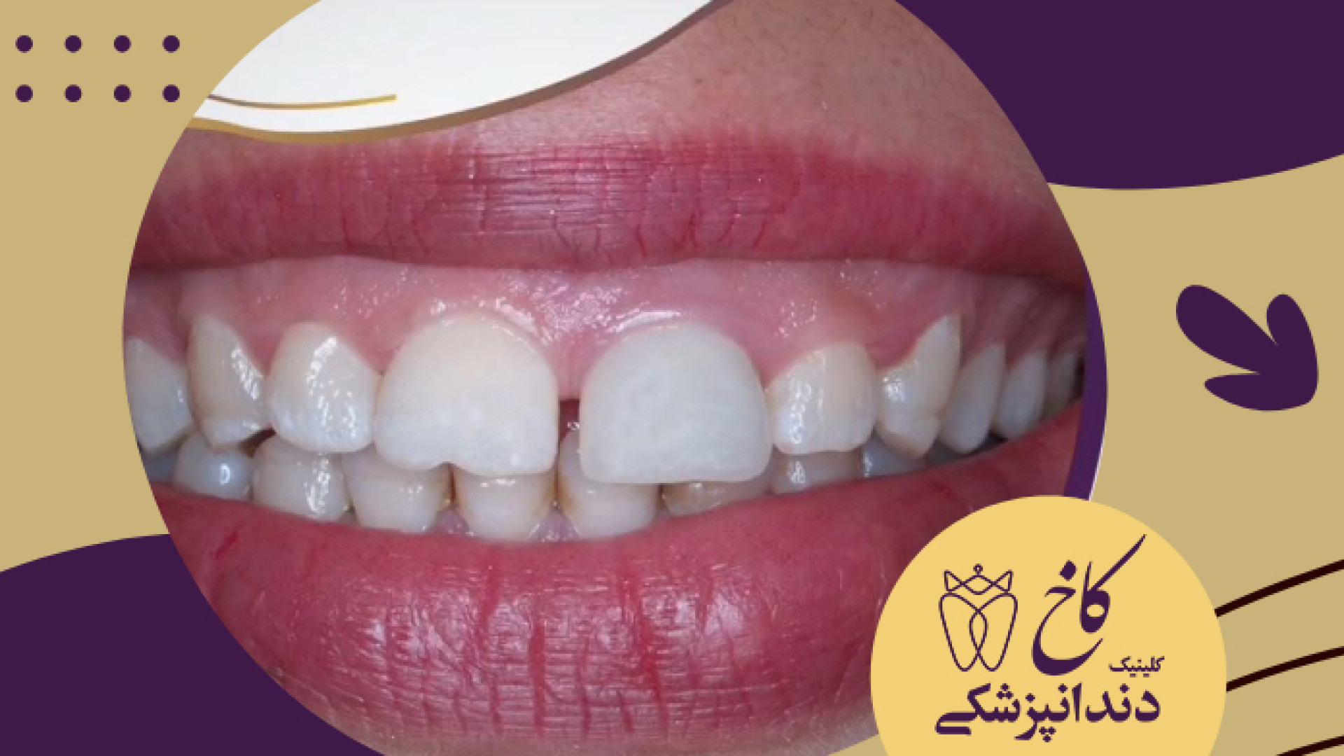 بازسازی روکش قدیمی دندان کلینیک دندانپزشکی کاخ
