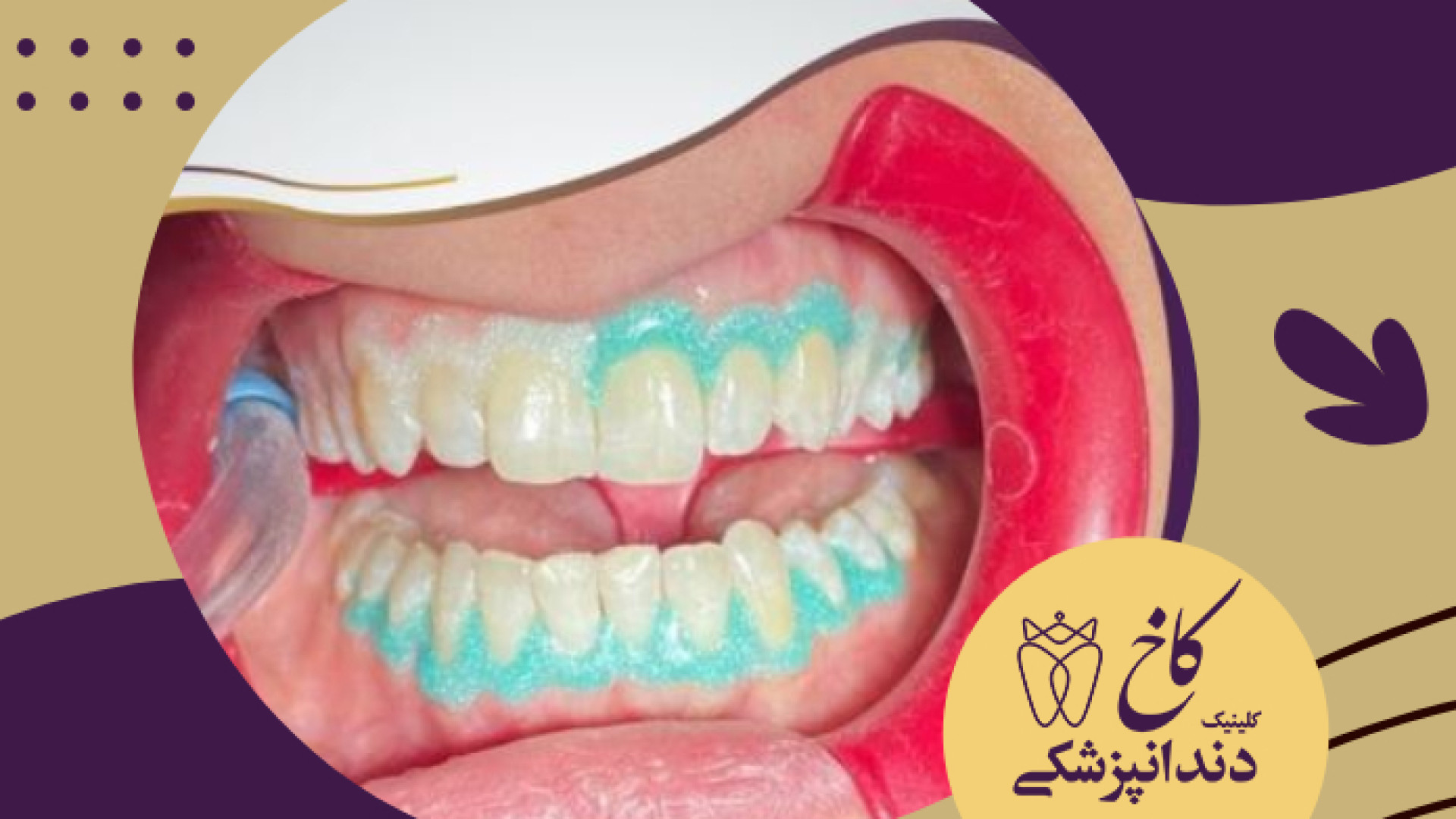 بلیچینگ آفیس در کلینیک دندانپزشکی کاخ کلینیک دندانپزشکی کاخ