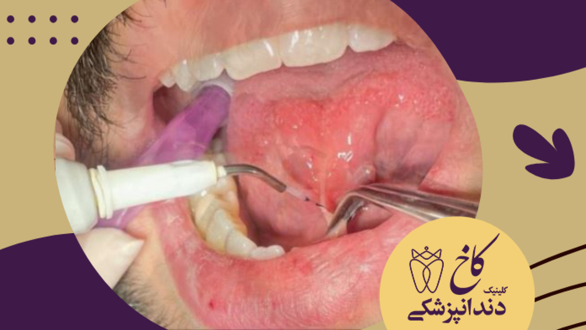 فرنکتومی و آزادسازی زبان کلینیک دندانپزشکی کاخ