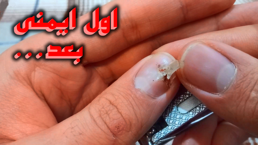 کندن ناخن شکسته