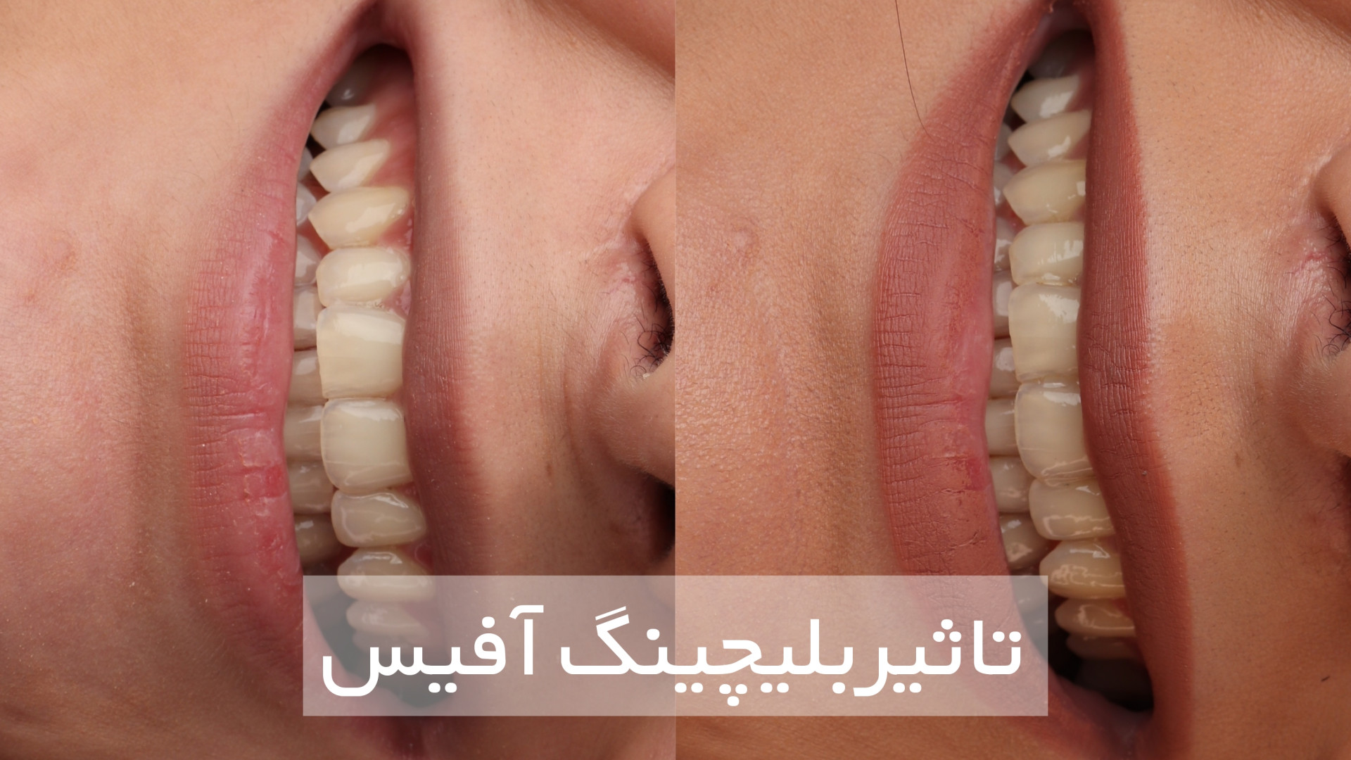 بلیچینگ آفیس بیماری سندرم فریمن شلدون