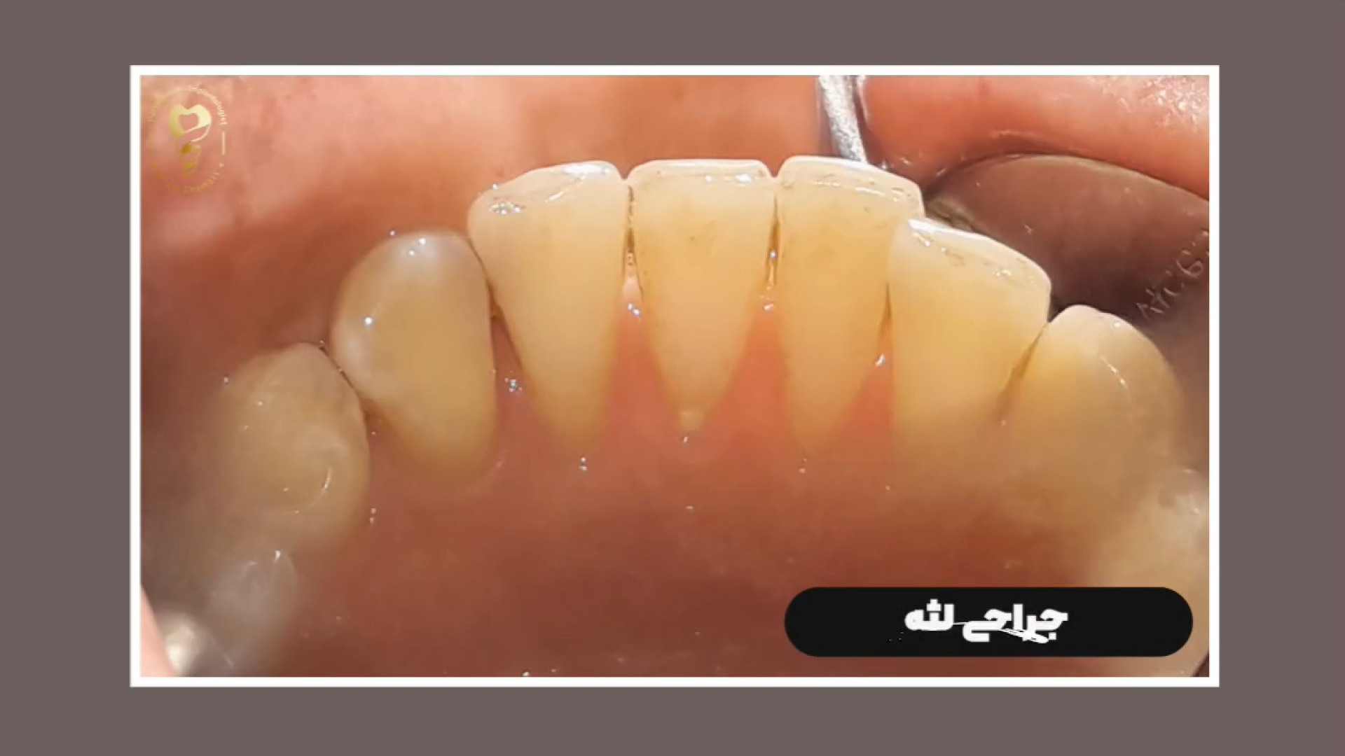فیلم جراحی پیوند لثه فک پایین دکتر علی قمری - متخصص جراحی لثه و ایمپلنت