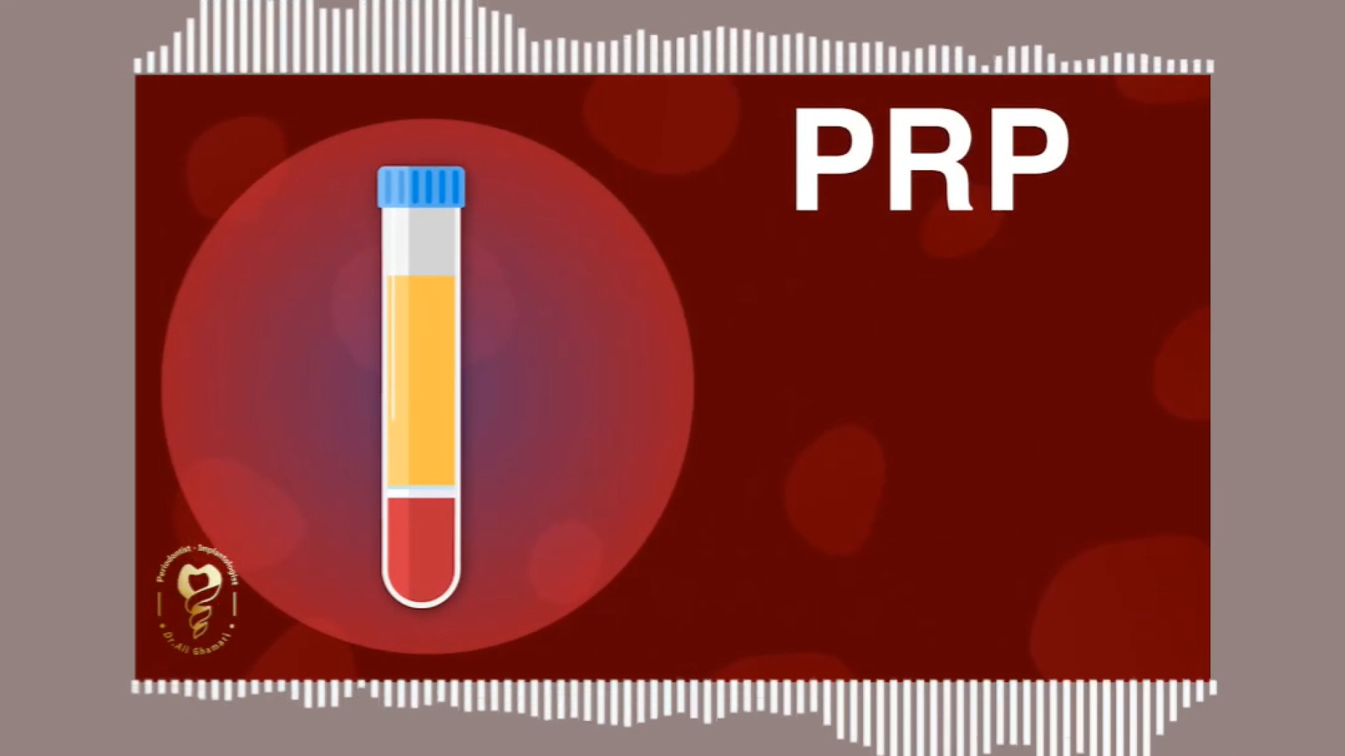 prf روشی نوین جهت ترمیم لثه استخوان دکتر علی قمری - متخصص جراحی لثه و ایمپلنت