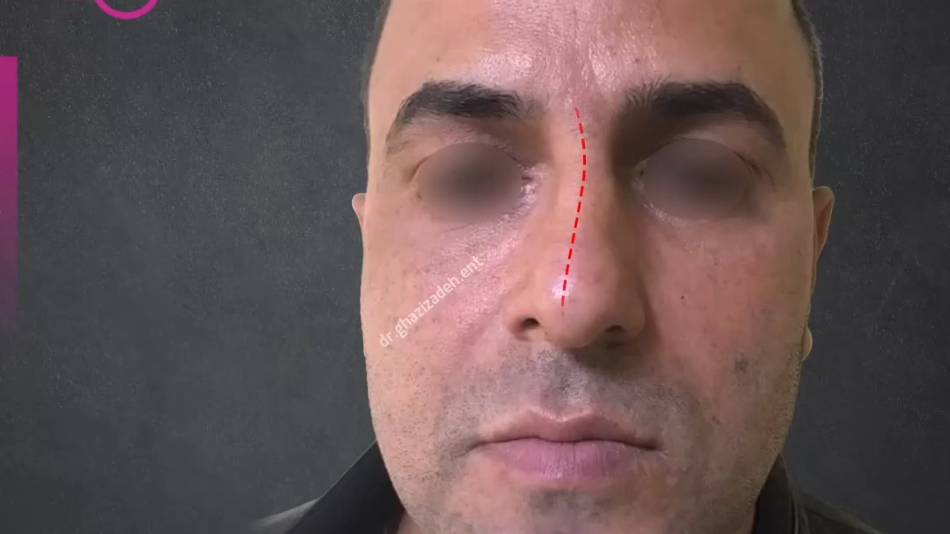 جراحی بینی با انحراف ظاهری و داخلی شدید بلیچینگ دندان