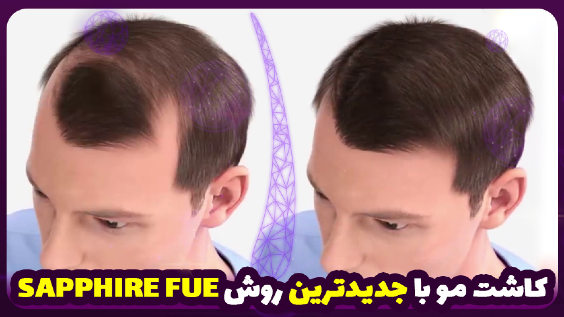 کاشت مو با جدیدترین روش 2024 (Sapphire FUE) پلی‌مایالژیا روماتیکا