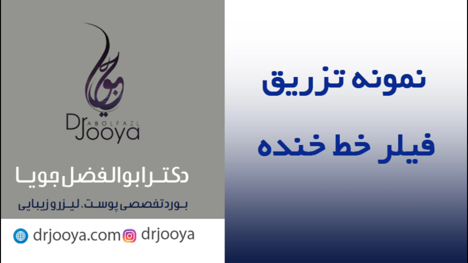 نمونه تزریق فیلر خط خنده | بهترین متخصص زیبایی اصفهان دکتر ابوالفضل جویا