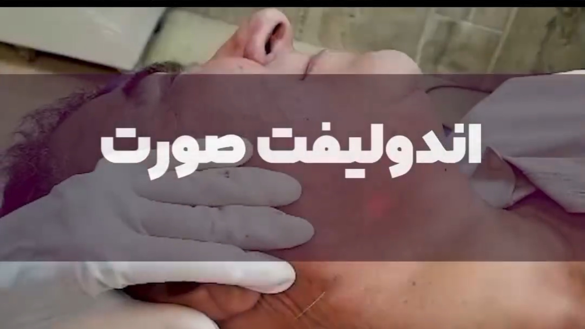 جوانسازی اندولیفت دکتر حمیده آقایی