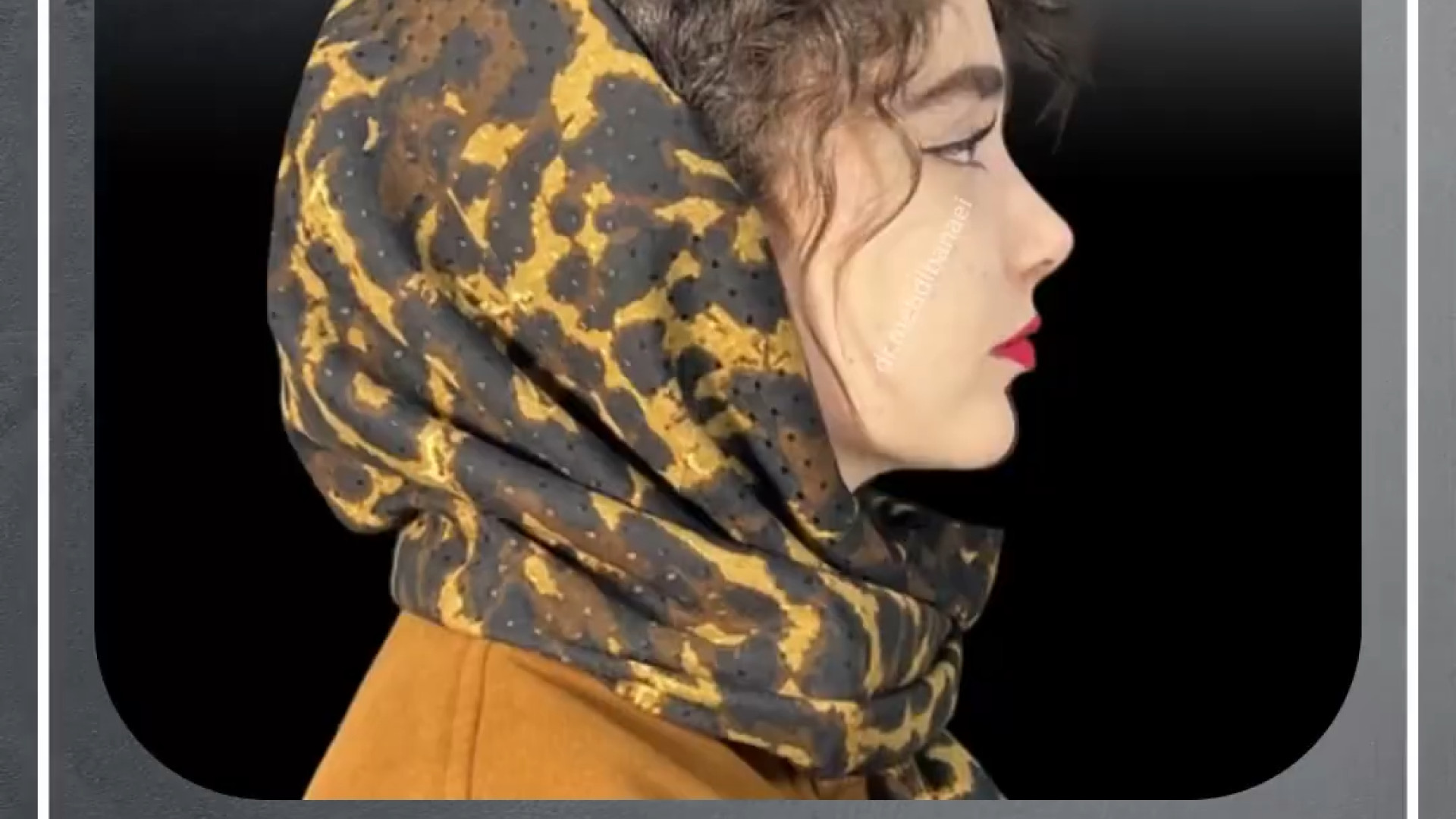 نتیجه فوق العاده جراحی بینی طبیعی