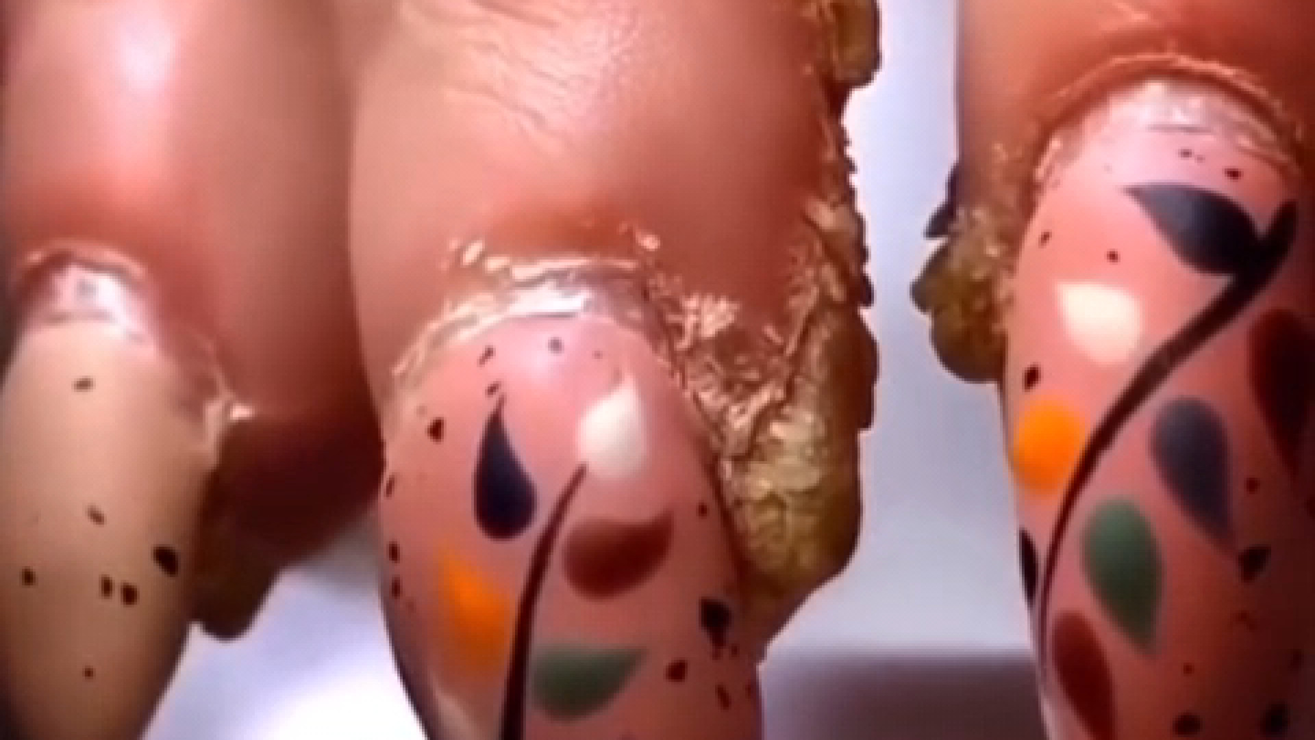 قاتل پسوریازیس نذار ناخن درگیر بشه Psoriasis کریس همسورث