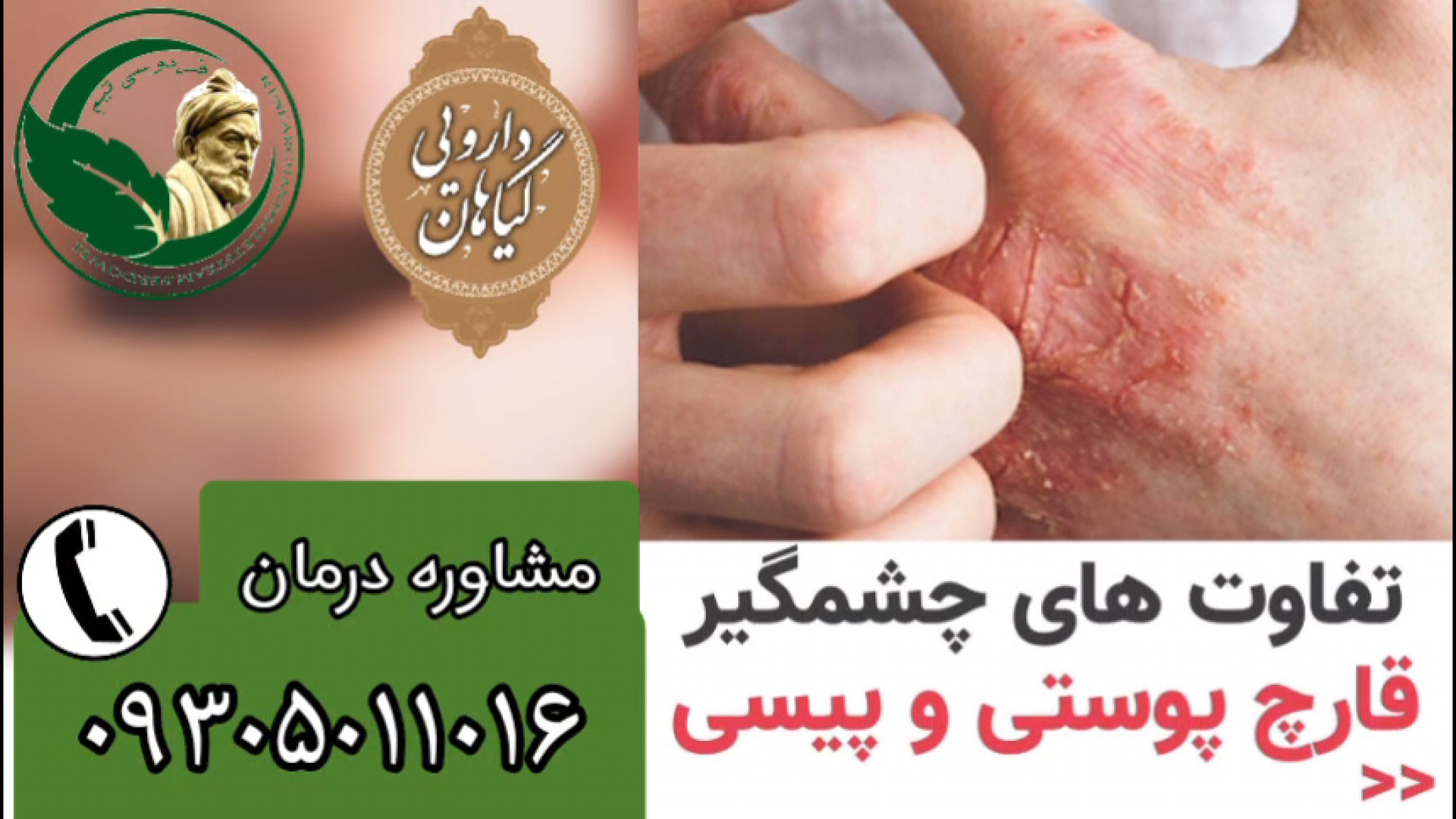 تفاوت قارچ پوستی و ویتیلیگو پیسی برص بهاق ویتیلایگو vitiligo پرت و پلا