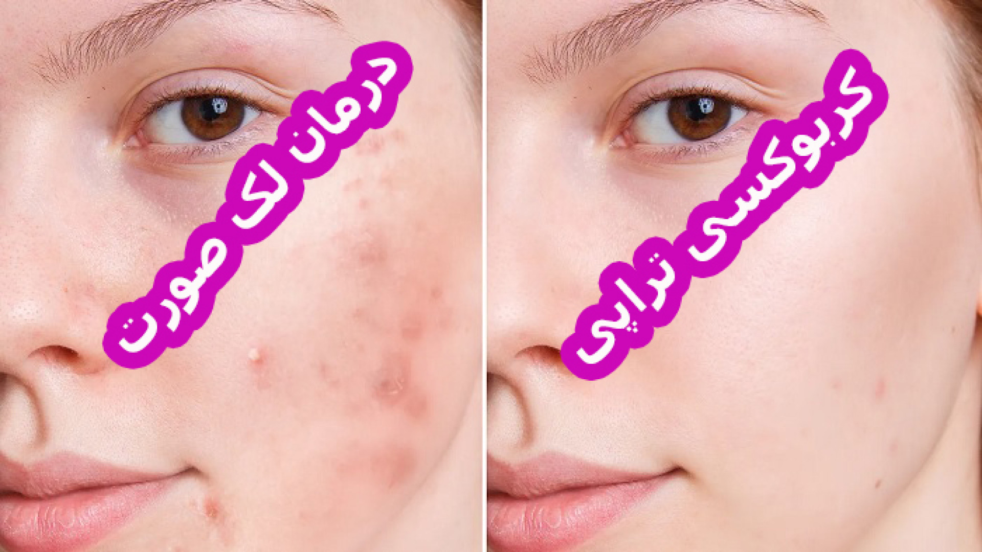 کربوکسی تراپی برای لک صورت در آکادمی پوست و مو صفائیان پوشش زخم هیدروکلوییدی