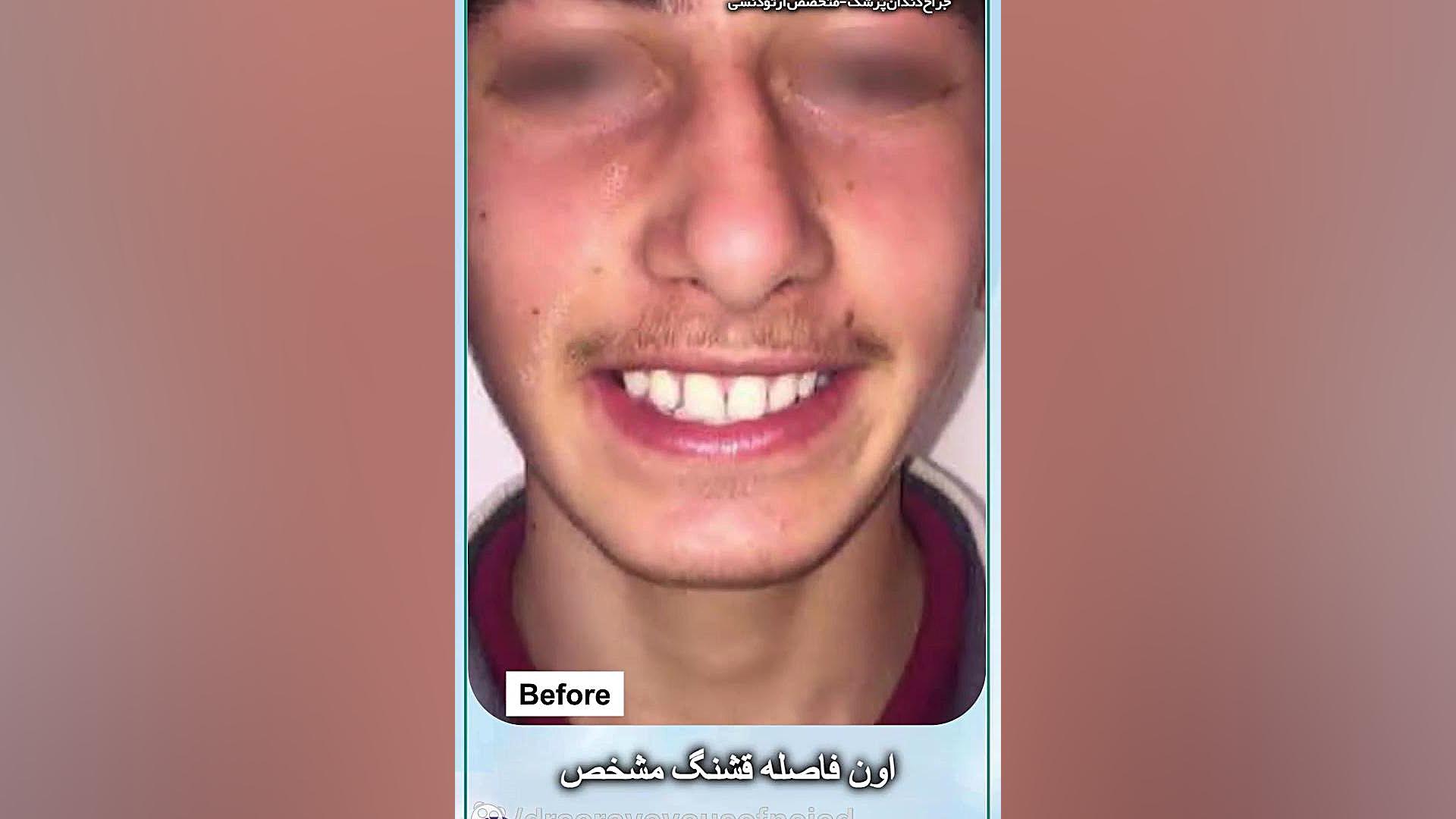 ناهنجاری کلاس دو دکتر ثریا یوسف نژاد متخصص ارتودنسی بابل