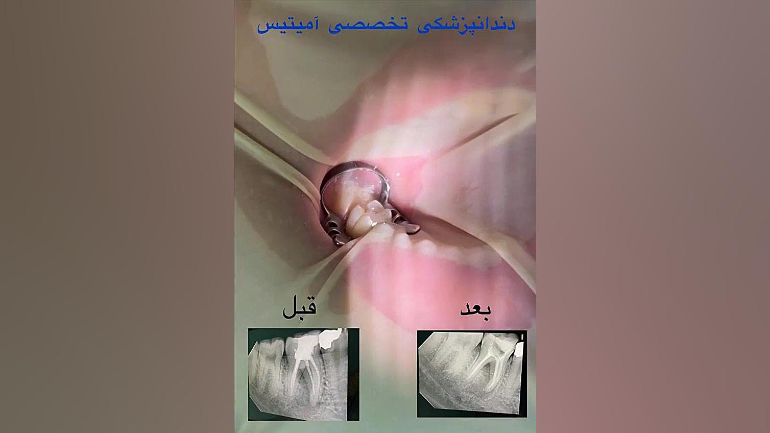 درمان مجدد عصب دندان فصل جدید