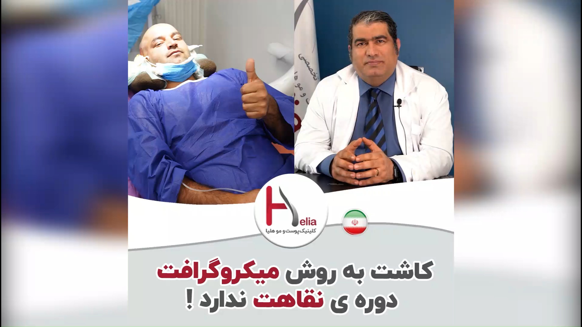 کاشت مو میکروگرافت: نقاهت کوتاه مدت، نتایج طولانی مدت سریال