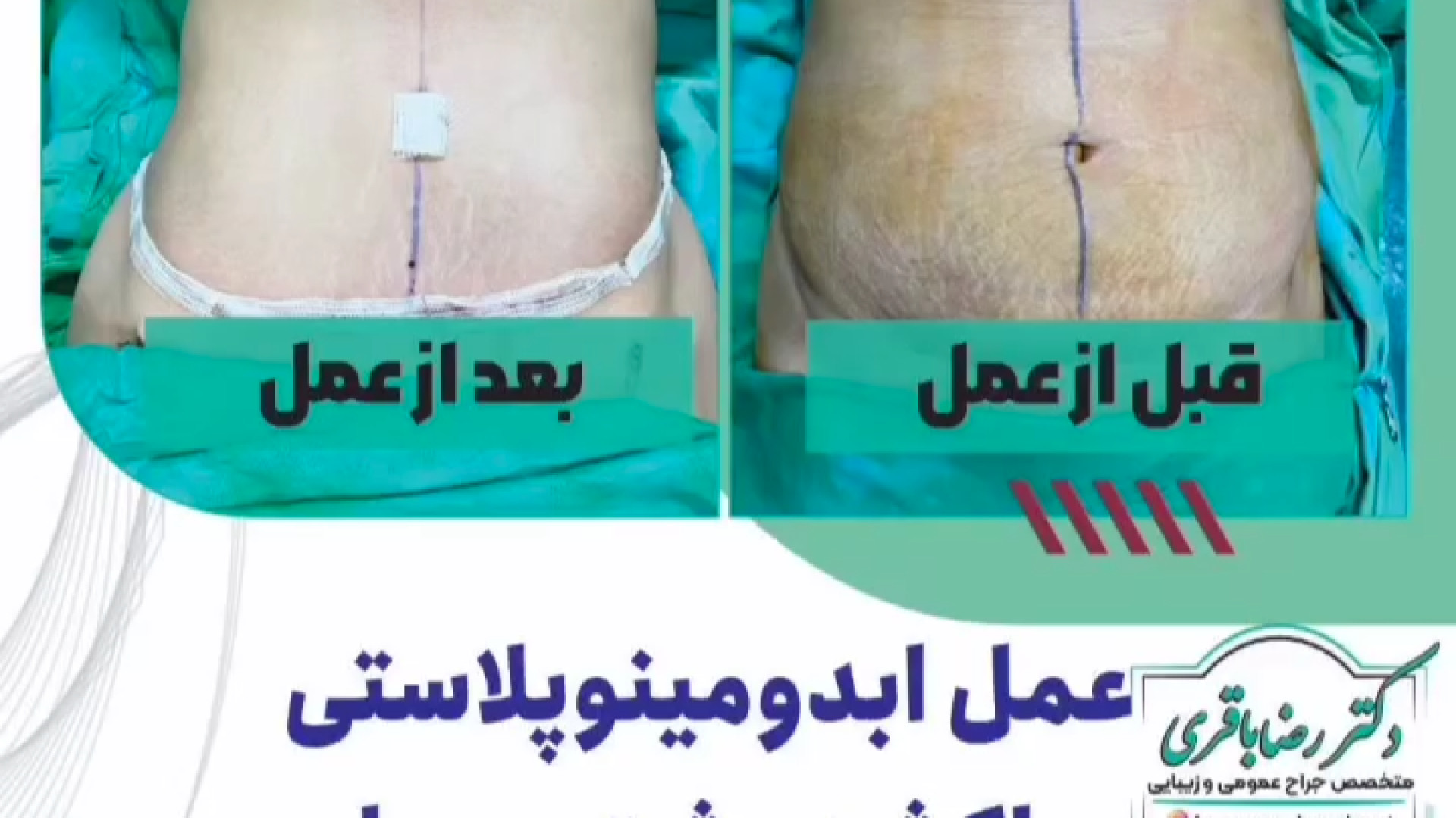 عمل ابدومینوپلاستی ساکشن پشت و پهلو و تزریق باسن دکتر رضا باقری جراح سینه در مشهد