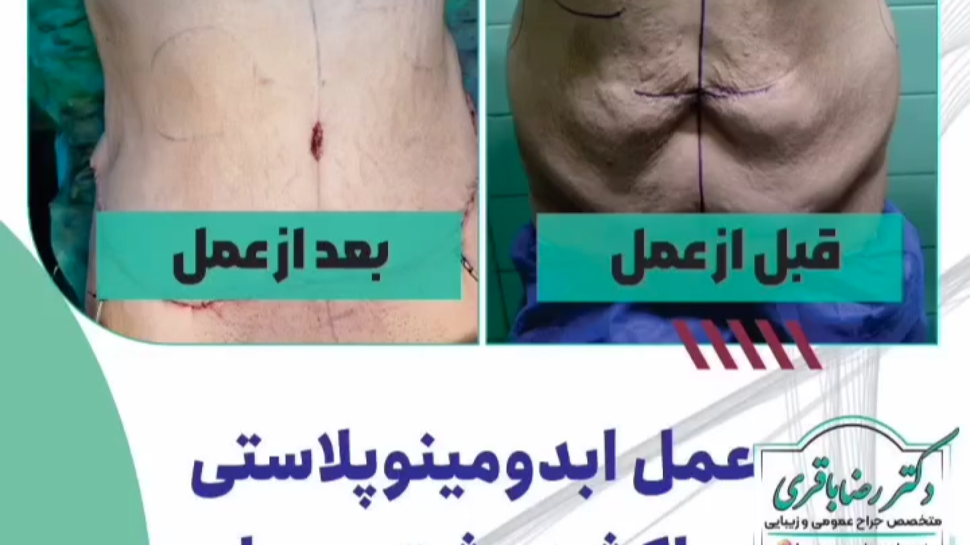 عمل ابدومینوپلاستی ساکشن پشت و پهلو و تزریق باسن دکتر رضا باقری جراح سینه در مشهد