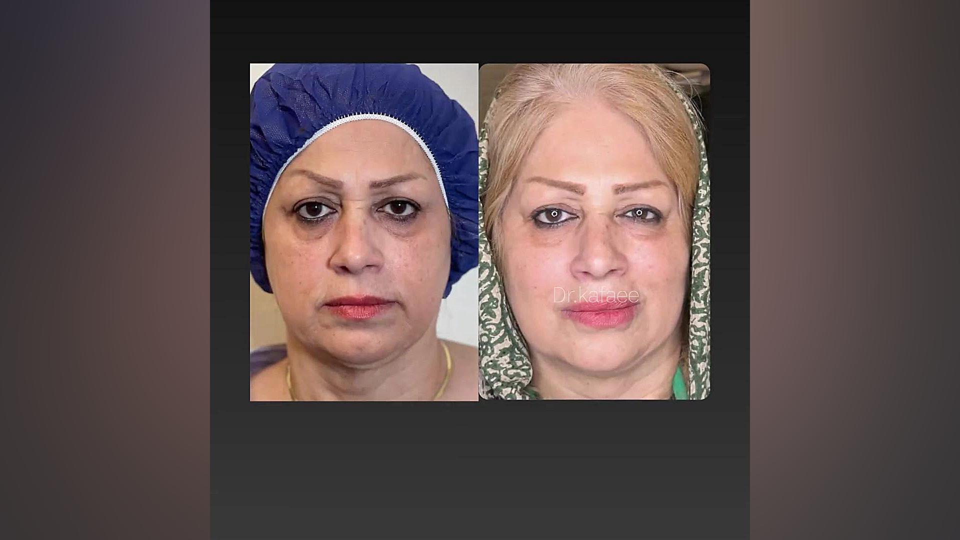 تزریق چربی به صورت | دکتر الهام کفایی PVRژنتیک پزشکی پیشرفته