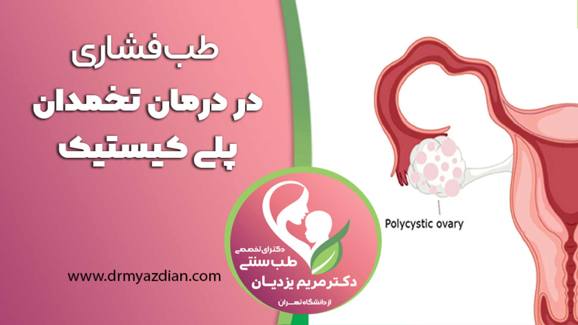 طب فشاری در درمان تخمدان پلی کیستیک درمان جای جوش
