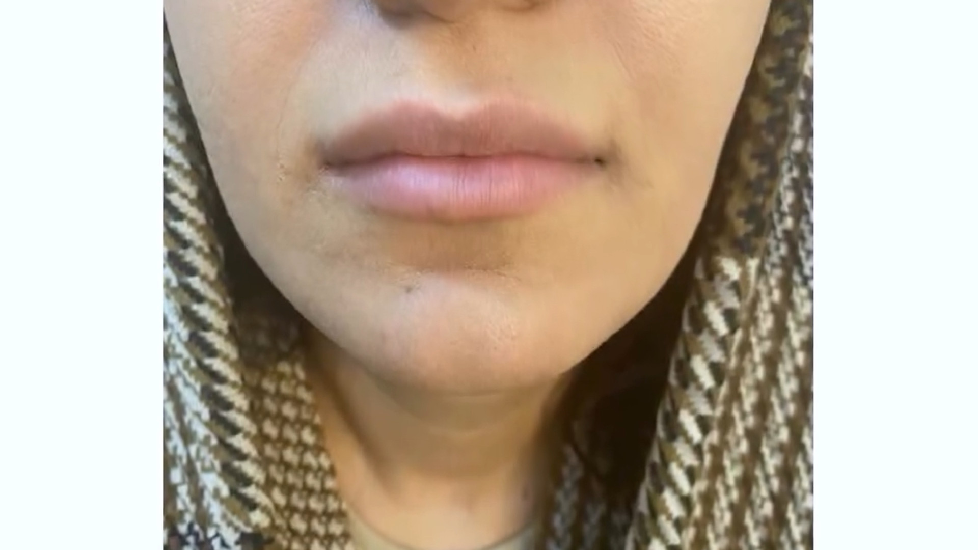 فرم دهی لب دکتر ربابه غیبی