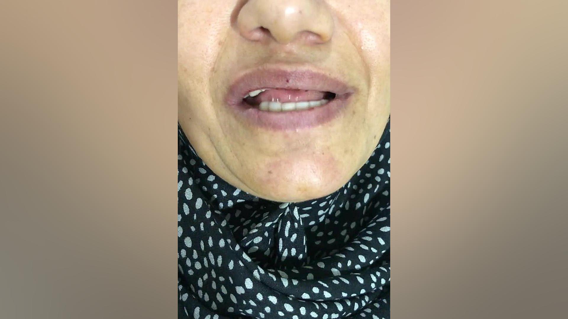 رضایت مراجعه کننده عزیز از جراحی کاشت ایمپلنت و پیوند استخوانGBr دکتر زکیه پورذکریا _دندانپزشک ایمپلنتولوژیست کرج