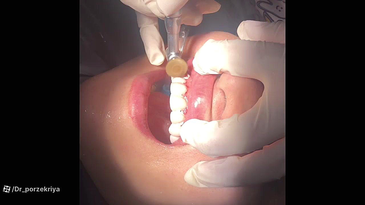 انجام ۲۰ واحد کامپوزیت ونییرcomposite veneer توسط دکتر پورذکریا دکتر زکیه پورذکریا _دندانپزشک ایمپلنتولوژیست کرج