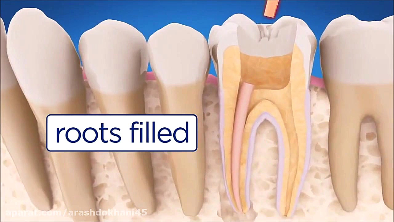 درمان ریشه دکتر آرش دخانی