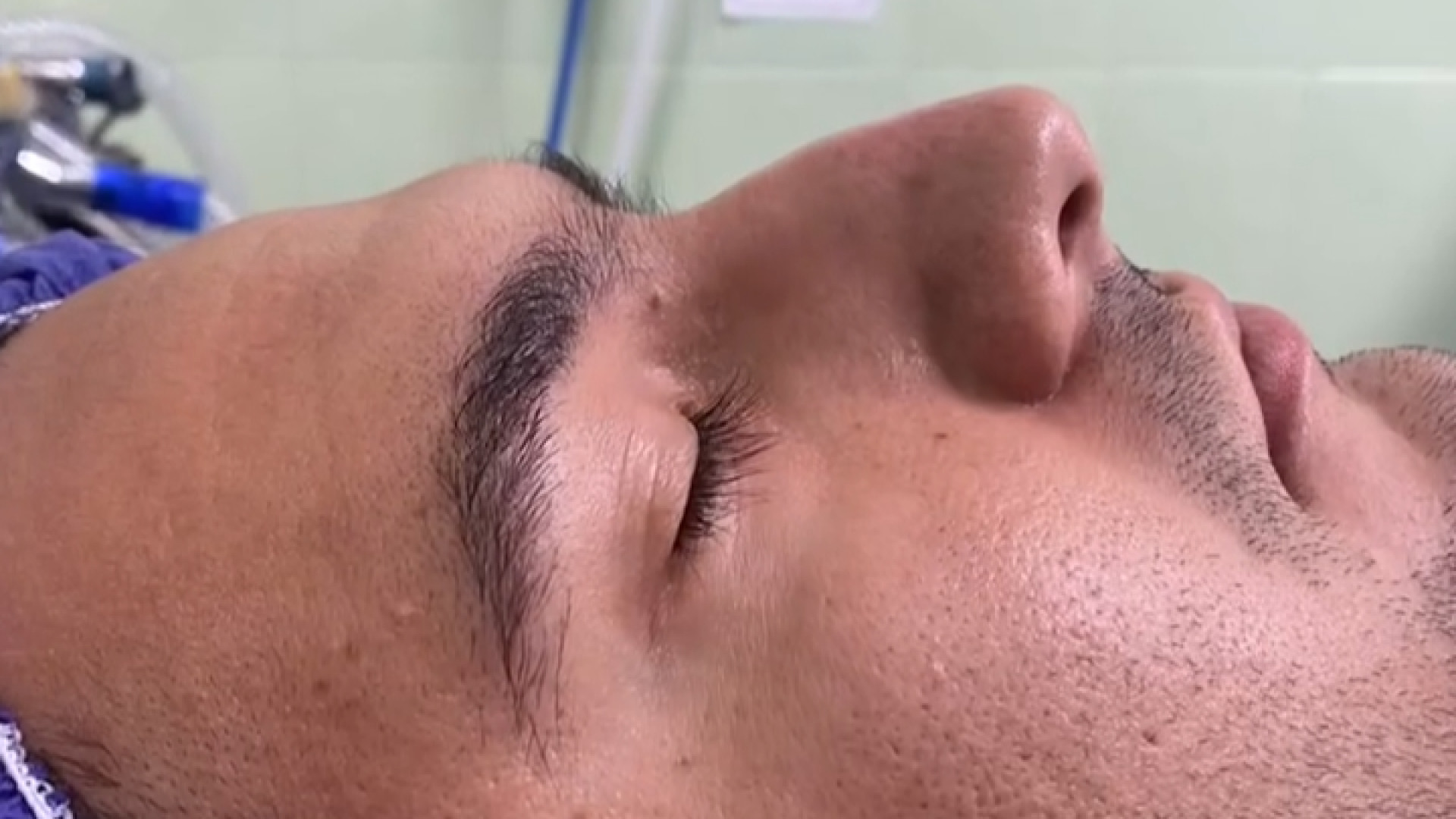 نمونه جراحی رینو پلاستی دکتر جواد رحمتی