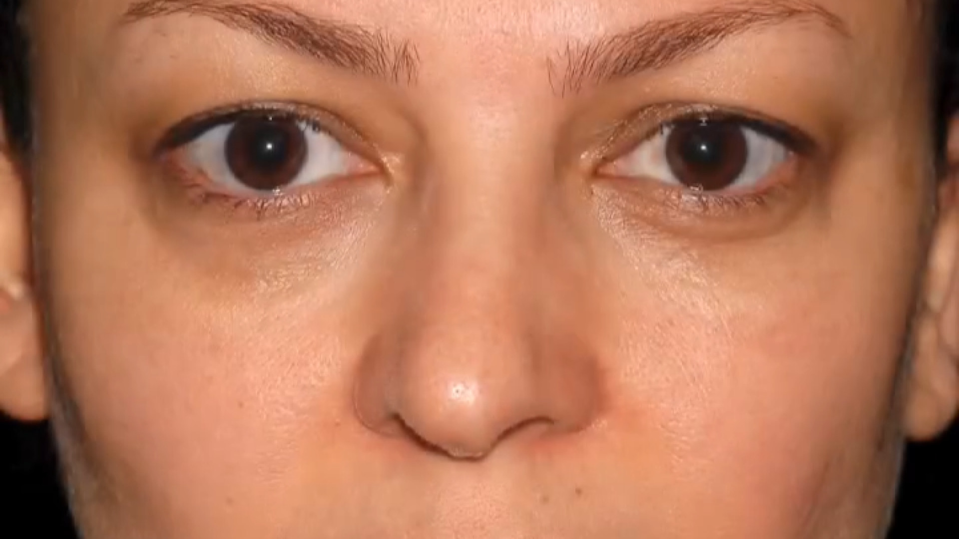 نتیجه عمل بلفاروپلاستی دکتر علیرضا بابایی،فوق تخصص جراحی پلاستیک و زیبایی