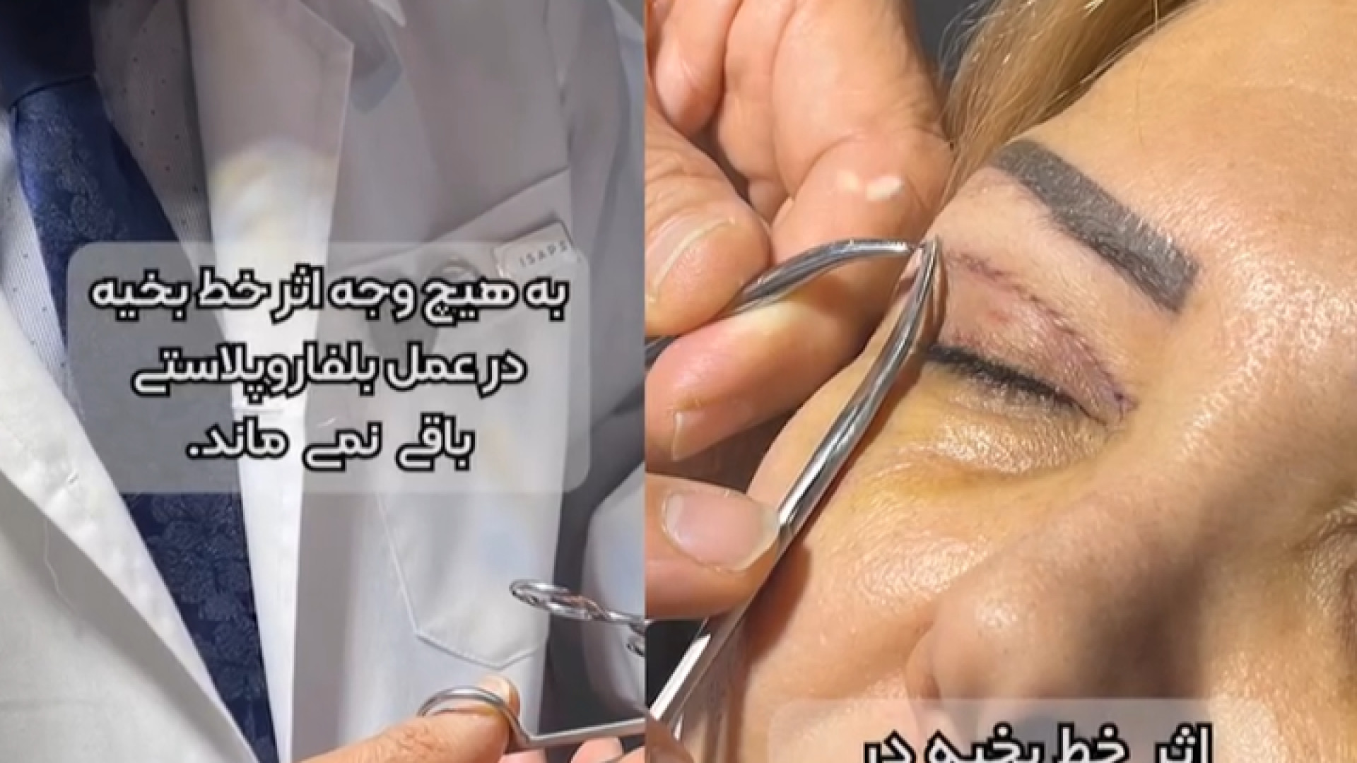 خط بخیه بلفاروپلاستی دکتر علیرضا بابایی،فوق تخصص جراحی پلاستیک و زیبایی