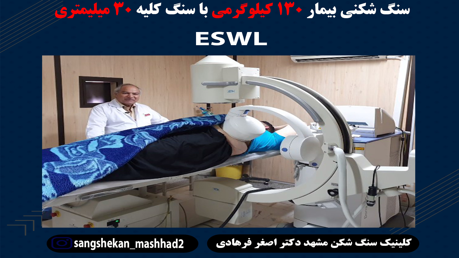 سنگ شکن سنگ کلیه 30 میلیمتری ESWL پوسیدگی دندان