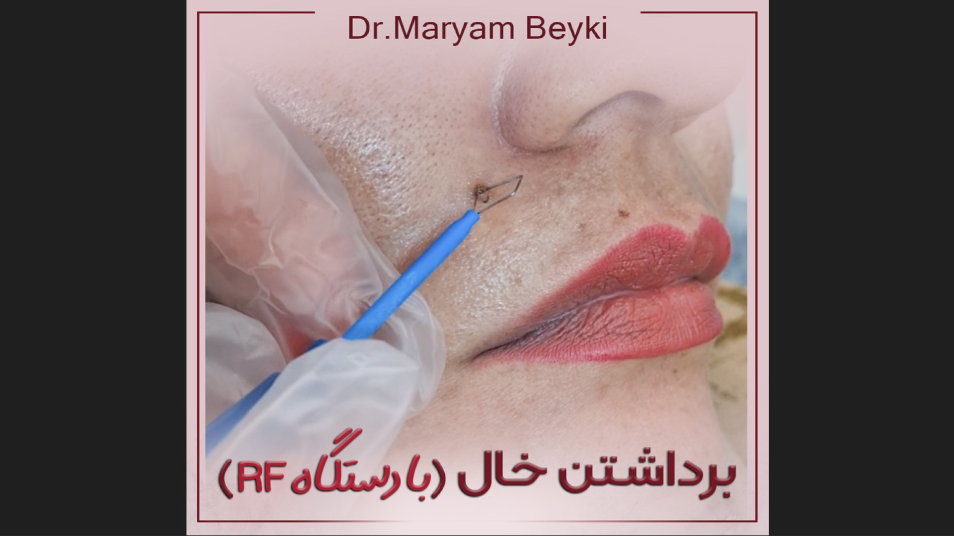 خالبرداری با دستگاه آر اف سرجیکال (RF) دکتر مریم بیکی - پوست و مو و زیبایی اراک