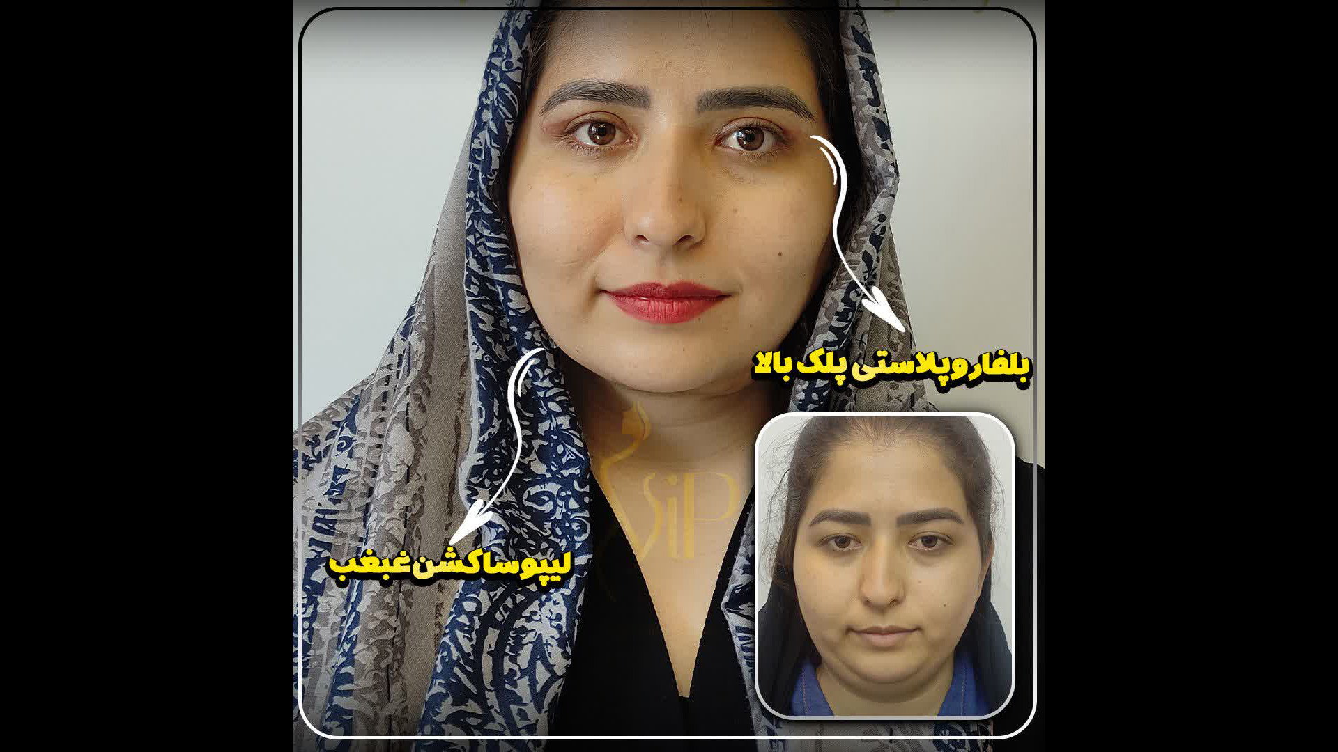 تغییرات بعد از لیپوساکشن غبغب تغییرات رو خودتون ببنید لیفت ابرو