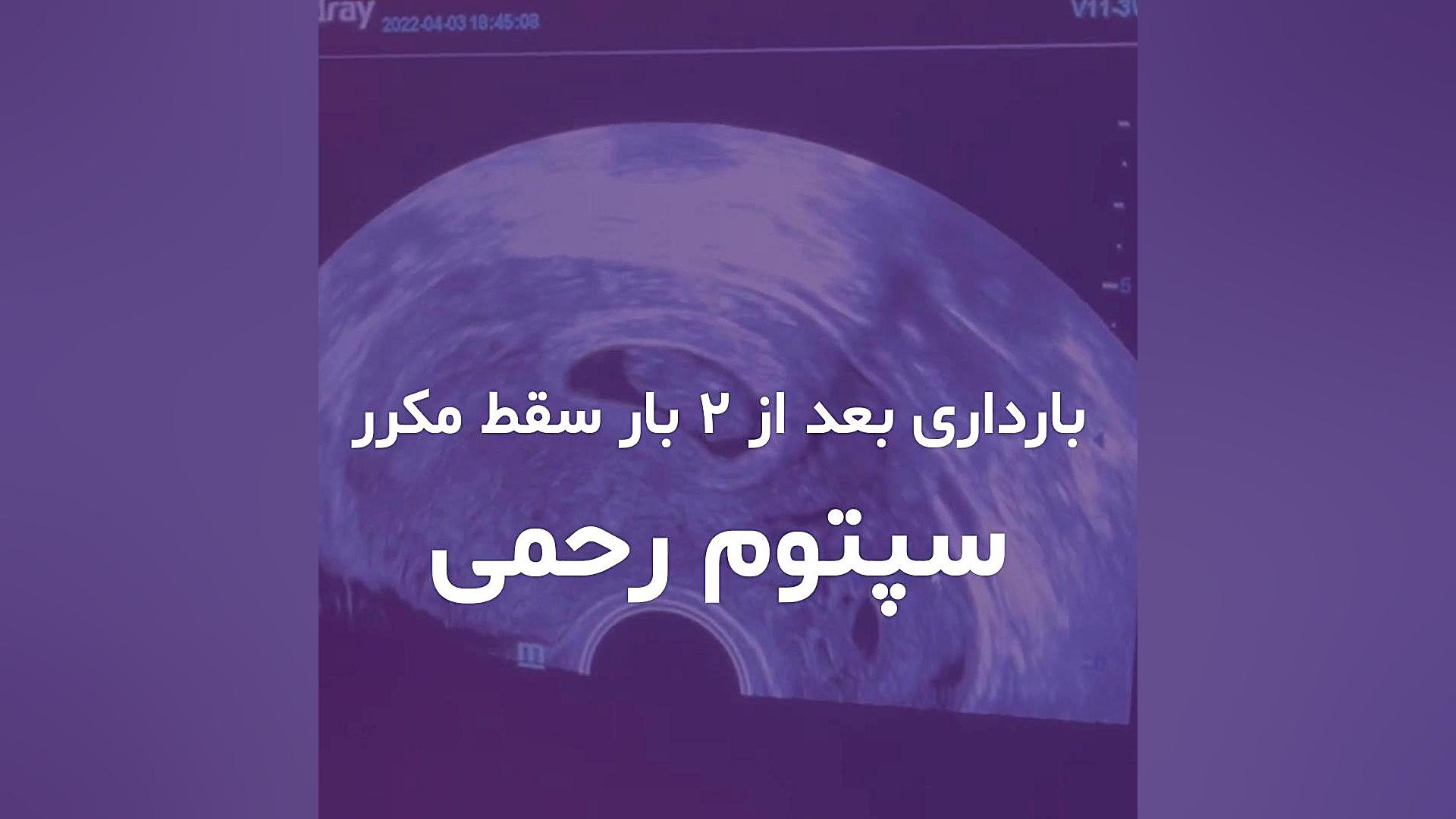 بارداری بعد از 2 بار سقط مکرر بدلیل سپتوم رحمی لیفت گردنایمپلنت دندان