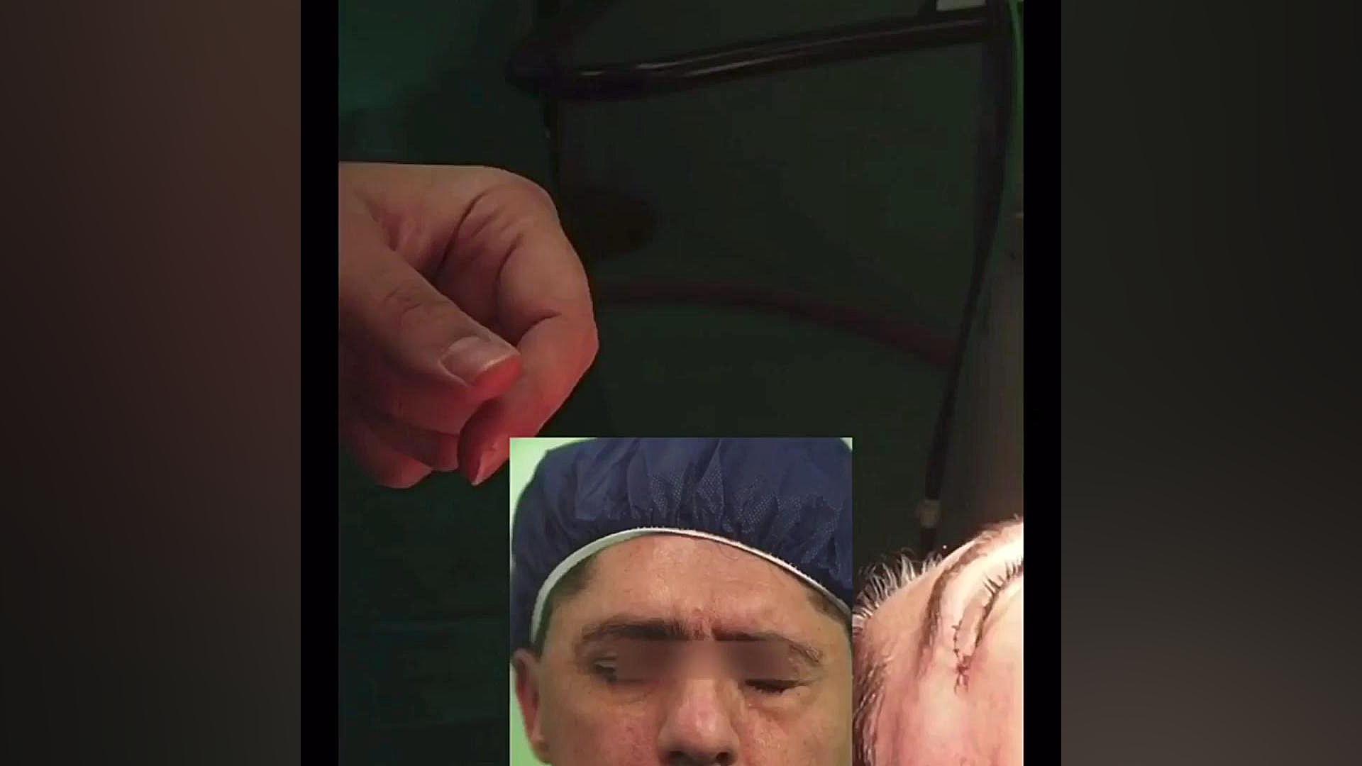 جراحی همزمان لیفت صورت و پیوند عصب صورت دندانپزشکی کودکان