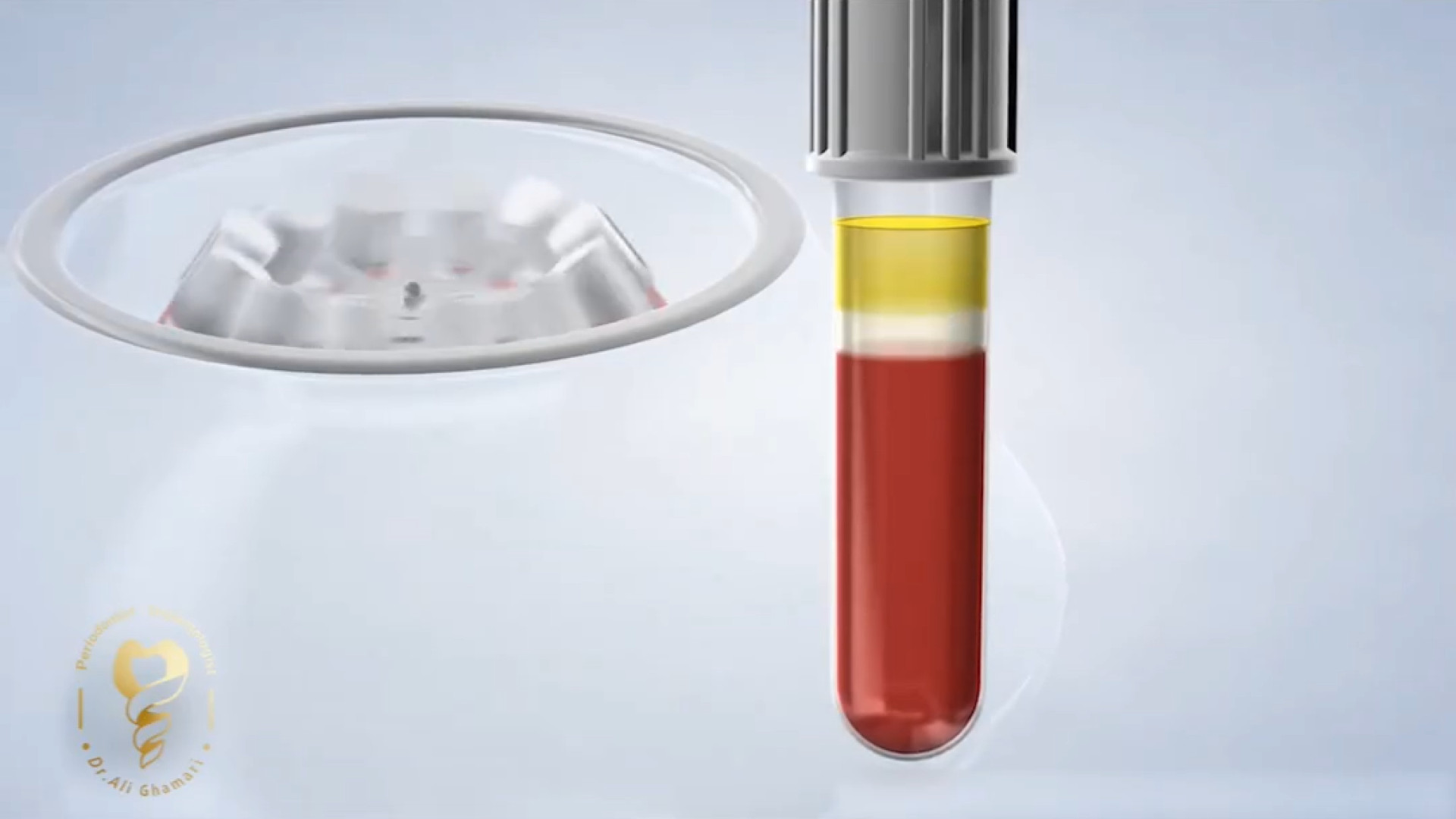 ترمیم لثه دکتر علی قمری - متخصص جراحی لثه و ایمپلنت