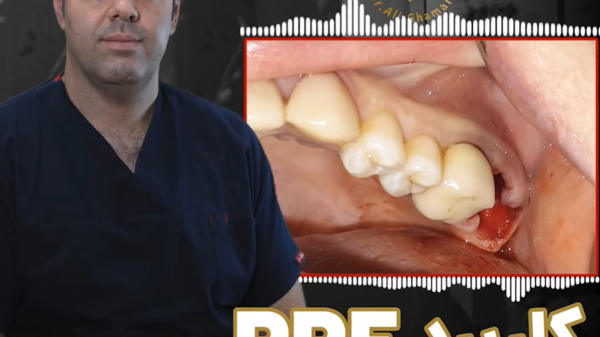 ترمیم لثه برای ایمپلنت دکتر علی قمری - متخصص جراحی لثه و ایمپلنت