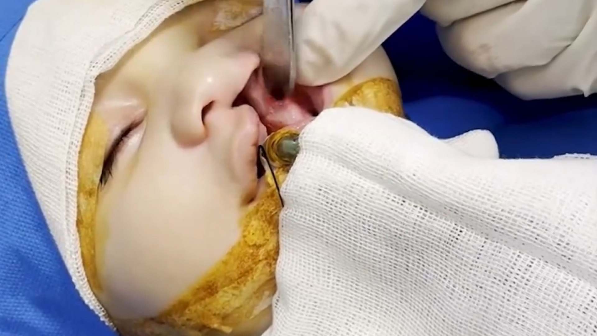 فیلم واقعی عمل شکاف کام و لب دکتر حمید رضا فتحی فوق تخصص جراحی پلاستیک