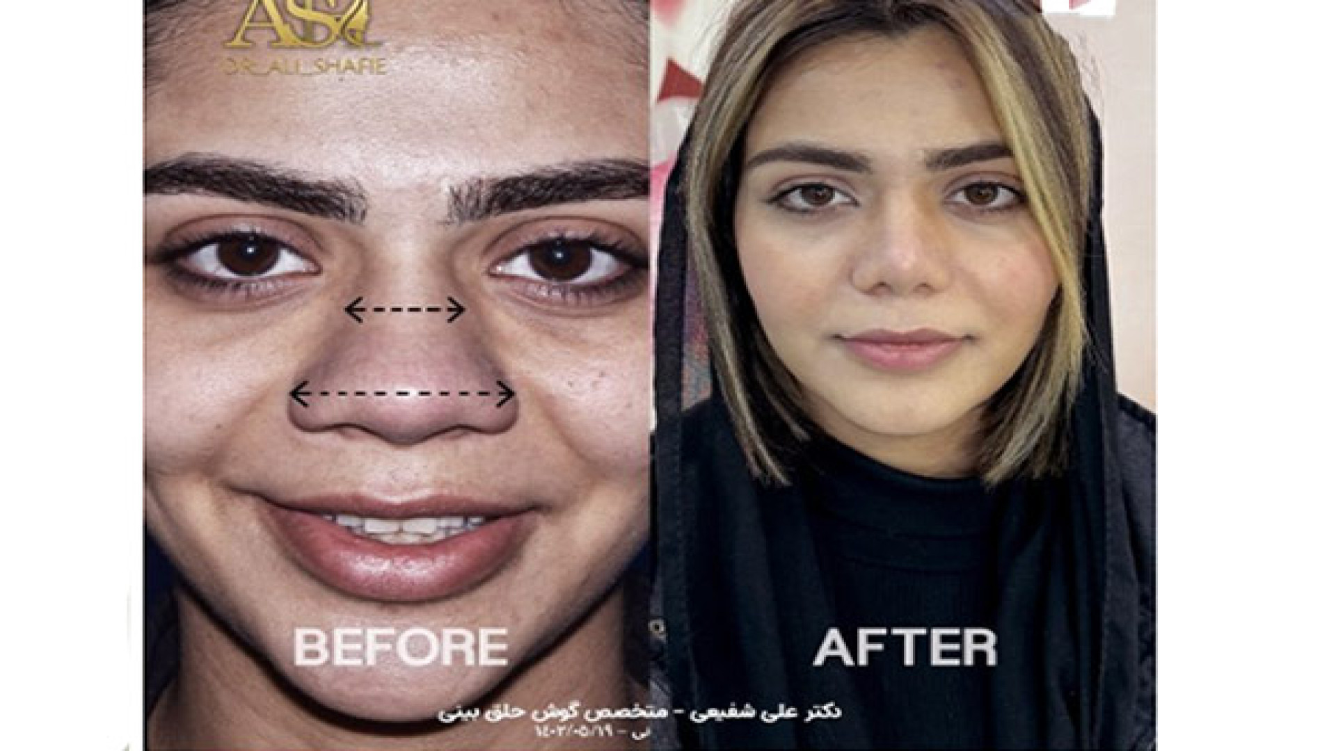 جراحی بینی گوشتی و پهن دکتر علی شفیعی رونیزی | بهترین جراح بینی تهران