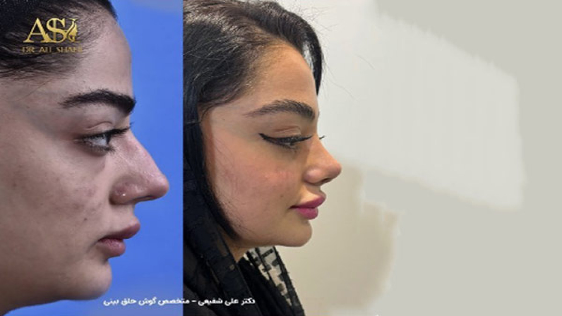 یک ماه بعد از جراحی بینی گوشتی با پوست حساس دکتر علی شفیعی رونیزی | بهترین جراح بینی تهران