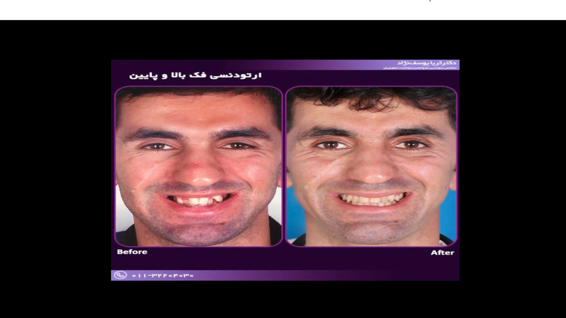 رضایت بیمار عزیز از اصلاح طرح لبخند دکتر ثریا یوسف نژاد متخصص ارتودنسی بابل
