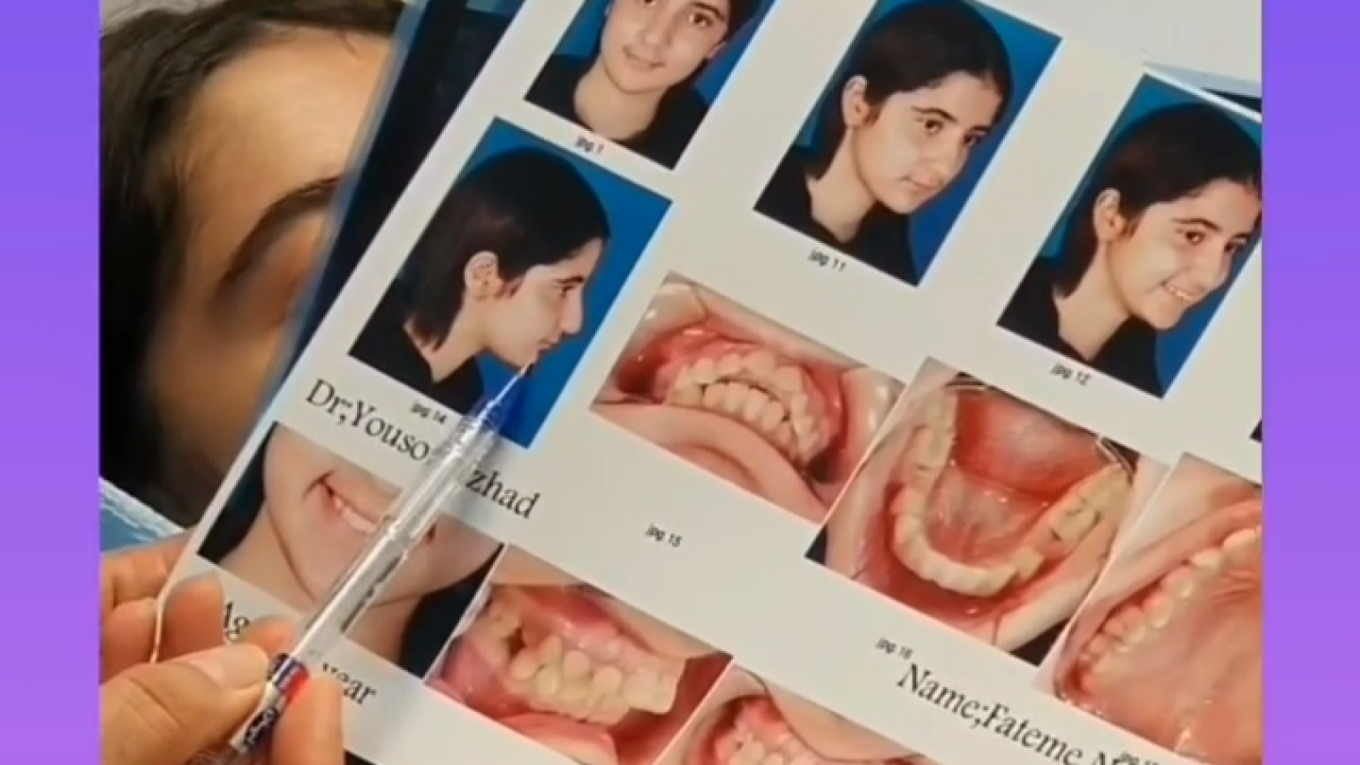کوچکی فک پایین دکتر ثریا یوسف نژاد متخصص ارتودنسی بابل