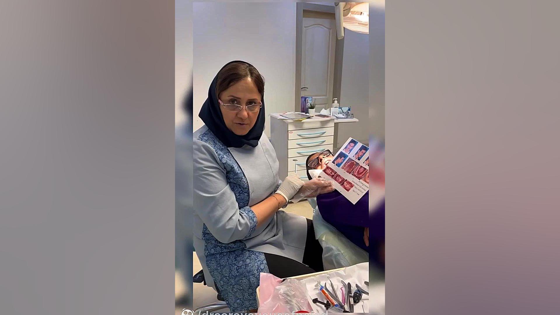 فیلرینگ شدید در فک بالا و پایین دکتر ثریا یوسف نژاد متخصص ارتودنسی بابل