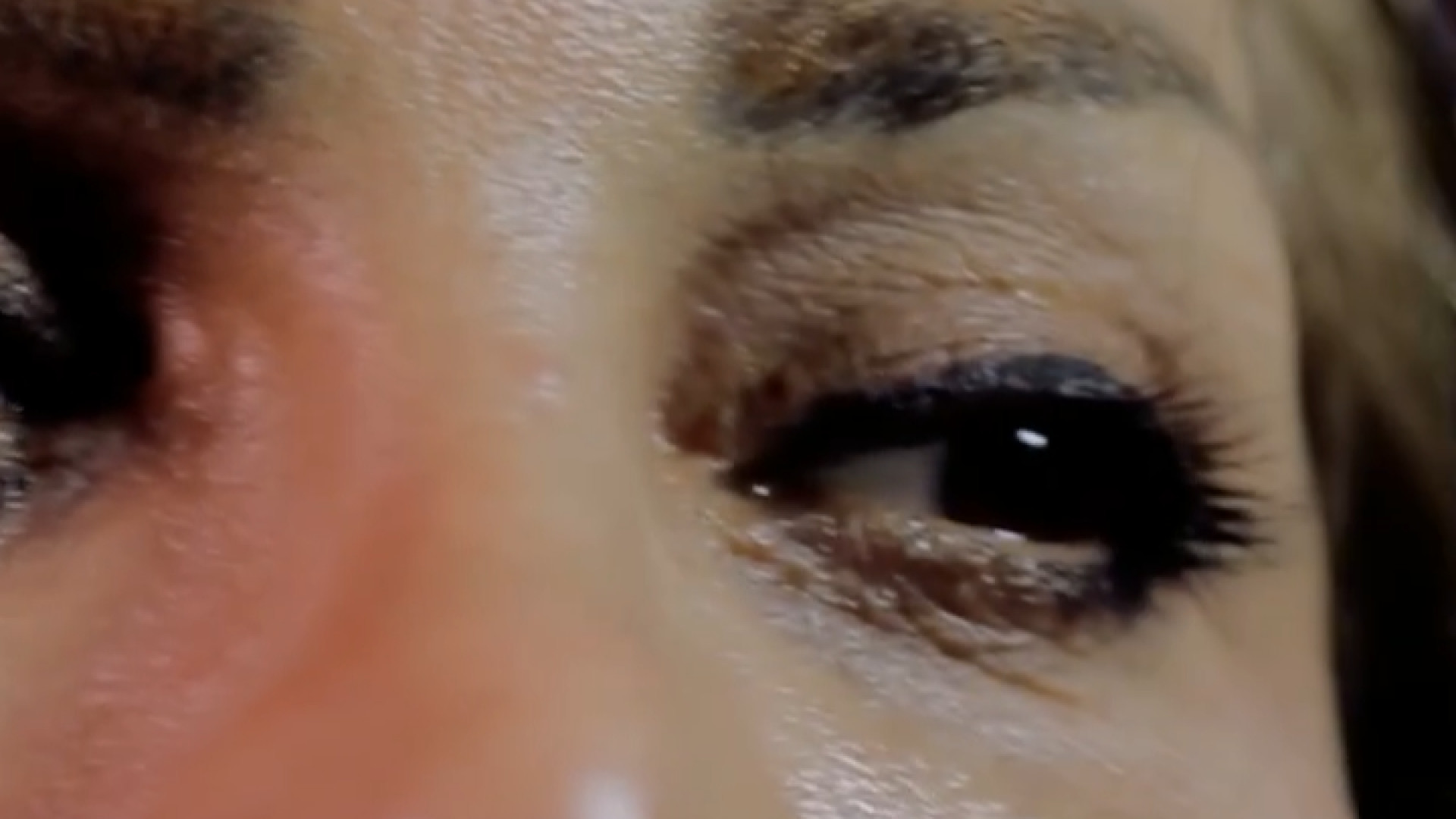 بلفاروپلاستی و لیفت همزمان دکتر شاهین بهجو - فوق تخصص جراحی پلاستیک