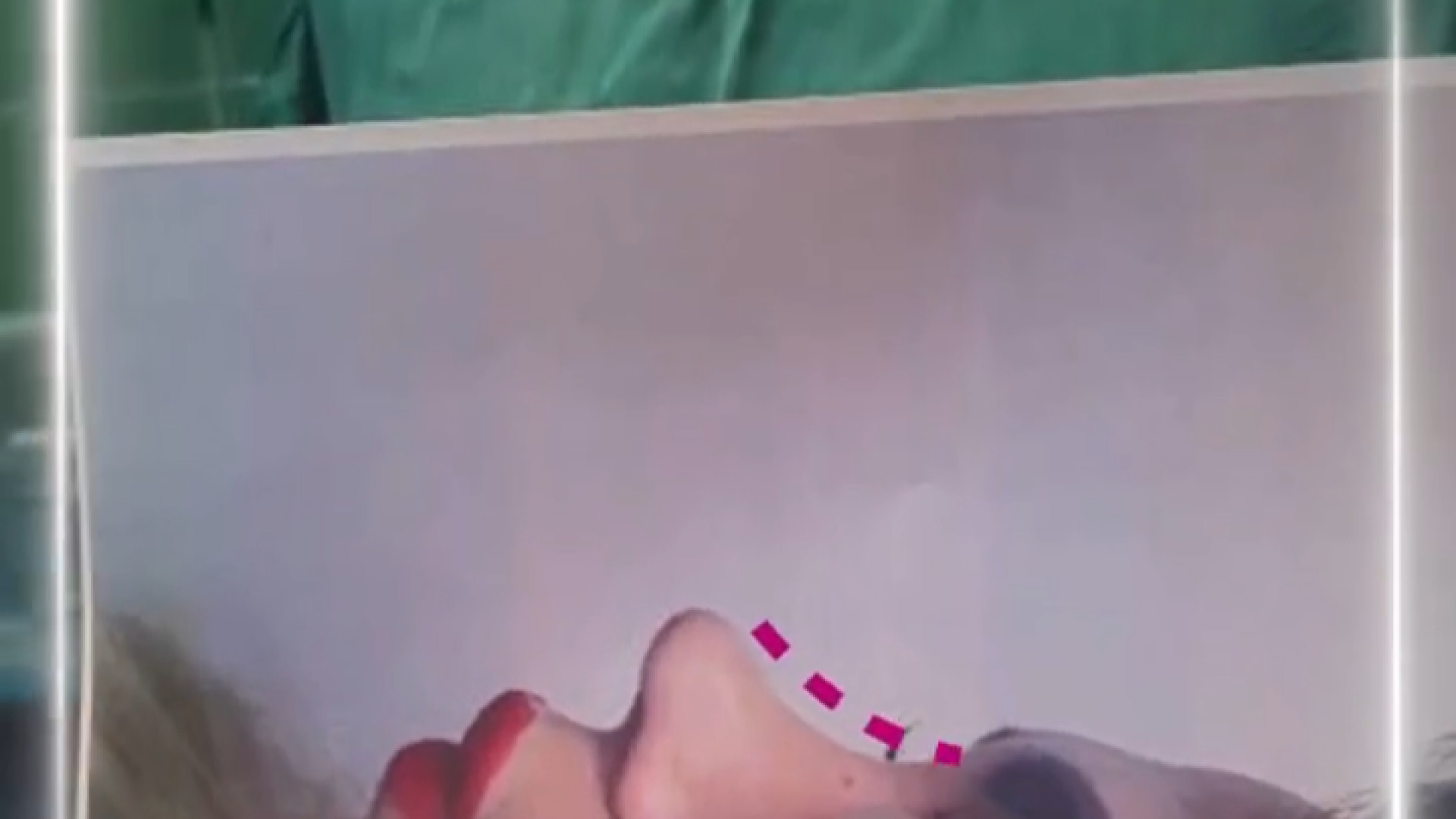 عمل بینی توسط دکتر محمودرضا اصحاب یمین دکتر محمودرضا اصحاب یمین - فوق تخصص پلاستیک