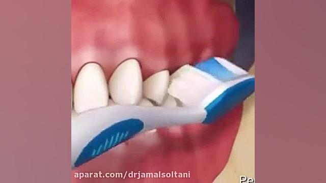 روش صحیح مسواک زدن دکتر جمال سلطانی دندانپزشک خوب در تبریز