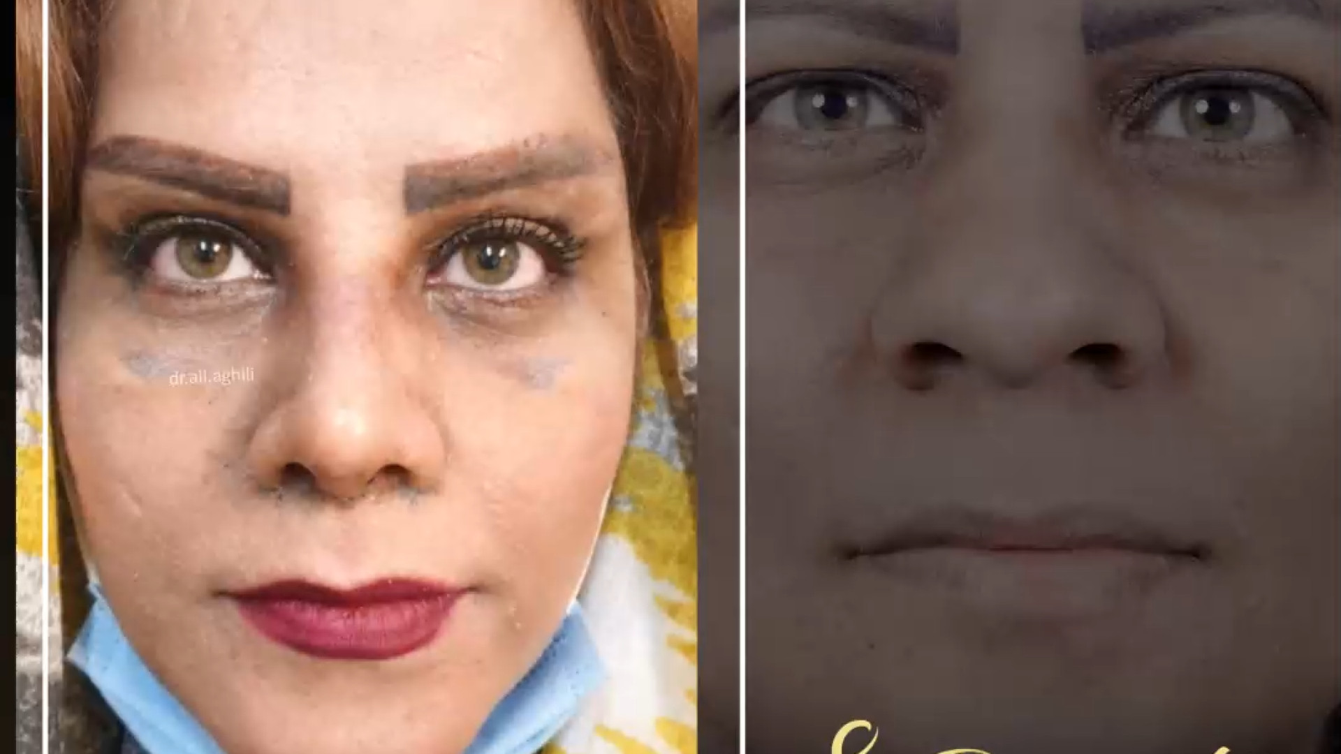 جراحی همزمان لیفت شقیقه، لیفت سانترال لب، جراحی بینی و پلک دکتر علی عقیلی - جراح بینی در تهران
