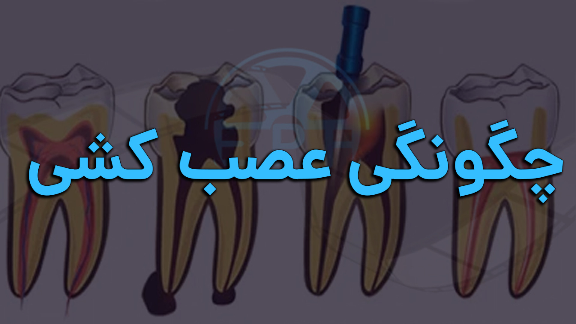 چگونگی عصب کشی بیماری اورنیتین ترانس کاربامیلاز